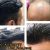 ترمیم مو و نصب پروتز مو در سالن تخصصی نیوفیس