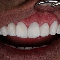 تخفیف دندانپزشکی در تهران برای کامپوزیت و ایمپلنت
