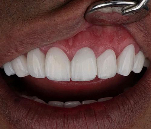 تخفیف دندانپزشکی در تهران برای کامپوزیت و ایمپلنت